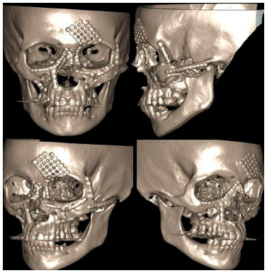 reconstrução tomografica 3d pós-cirurgico reconstrução tomografica 3d pós-cirurgico