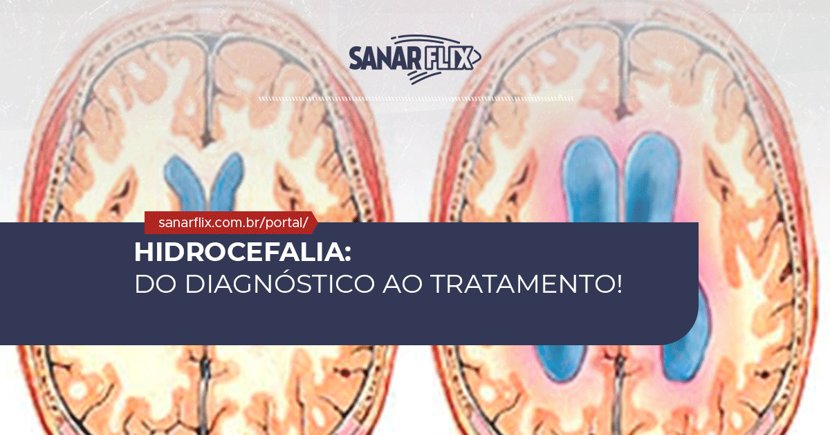 Síntomas de emergencia de hidrocefalia