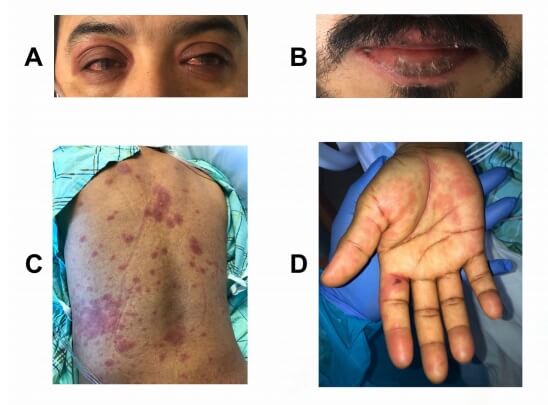 Apresentações da Síndrome inflamatória multissistêmica em adulto com COVID-19