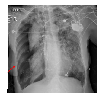 Figura 1. Pneumotórax em hemitórax direito em radiografia de tórax realizada em leito. (Fonte: ULAKES Journal of Medicine).