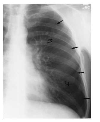 Figura 2. Linha pleural visceral em pneumotórax. (Fonte: BRANT. Fundamentos de Radiologia).