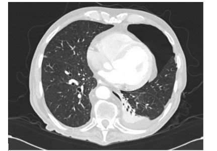 Figura 3. TC de pneumotórax a esquerda. (Fonte: BRANT. Fundamentos de Radiologia).