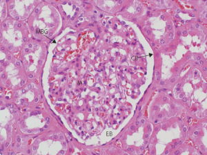 Glomerulonefrite Rapidamente Progressiva Colunistas Sanarmed