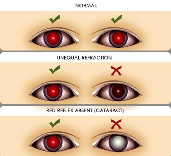 рефлекс с глазного дна при катаракте. кроссовки рефлекс рыжие. Reflex n 100 литров красный. мнимое косоглазие световой рефлекс. школа векторного массажа и соматики - колени.