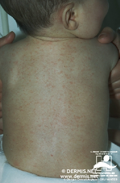 Doencas Exantematicas Eritema Infeccioso E Exantema Subito Colunistas Sanar Medicina