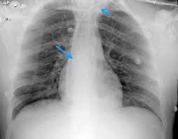 Sondas, cateteres e outros aparatos médicos na radiografia de tórax no acesso venoso central