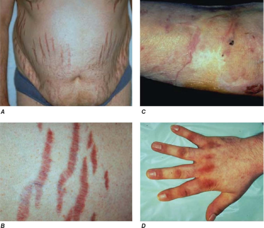 Síndrome de Cushing Colunista Sanar Medicina