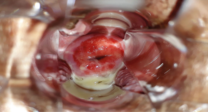 Exame especular demonstrando cervicite mucopurulenta por gonorreia.