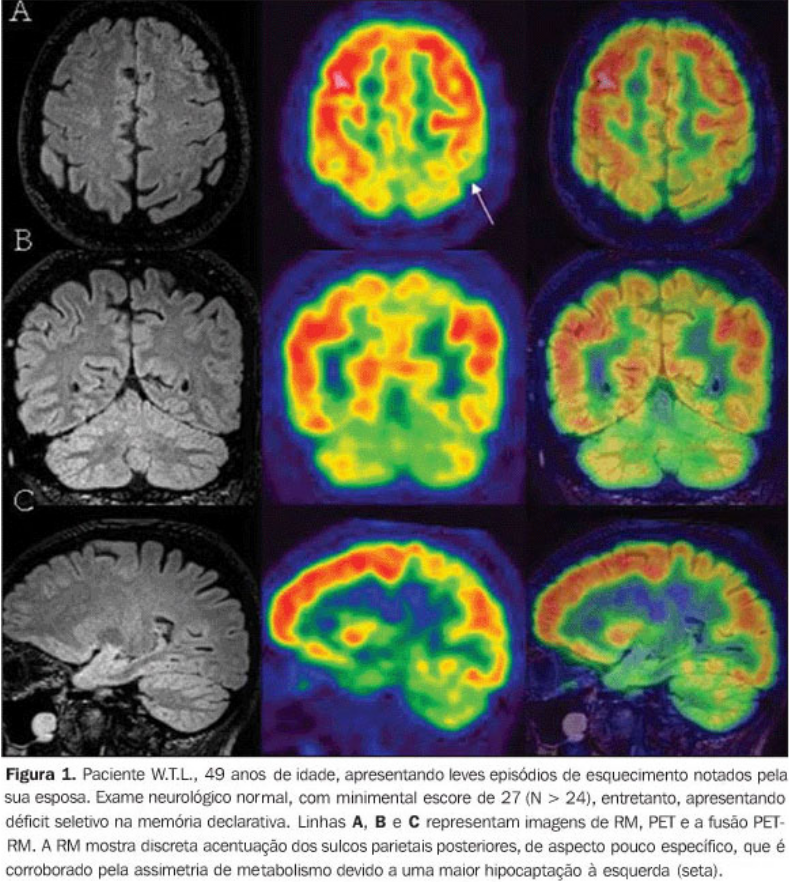 Doenças neurológicas tipos, principais sintomas, diagnóstico